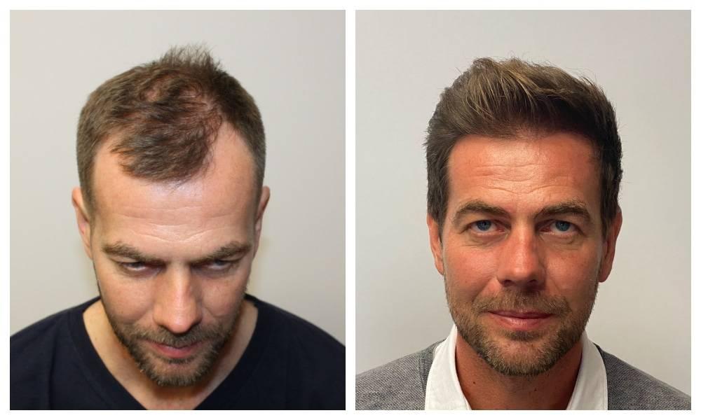 how much does a hair transplant cost uk